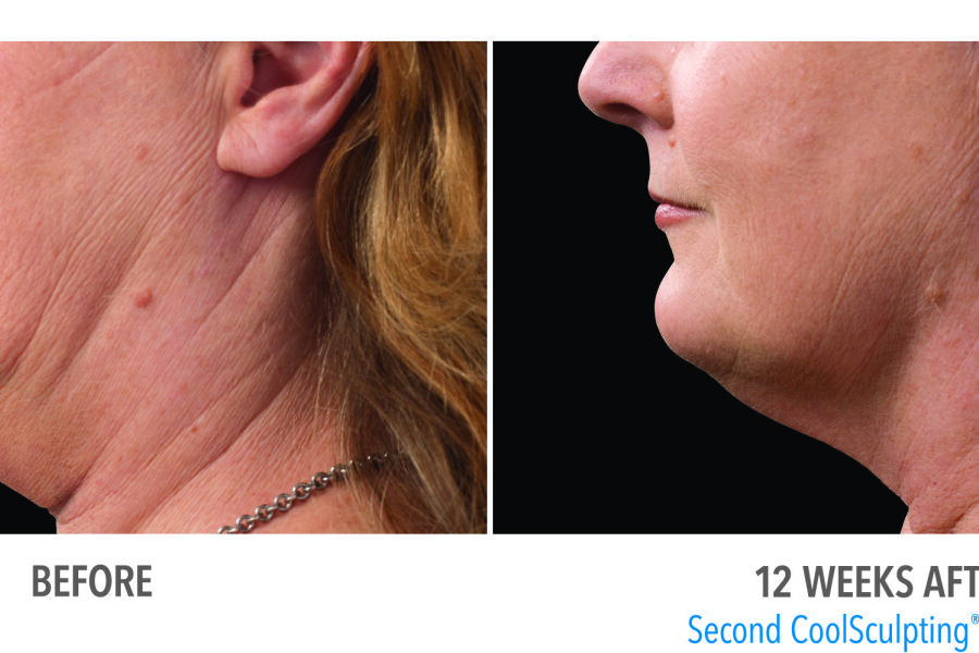 coolsculpting for double chin scottsdale chandler az