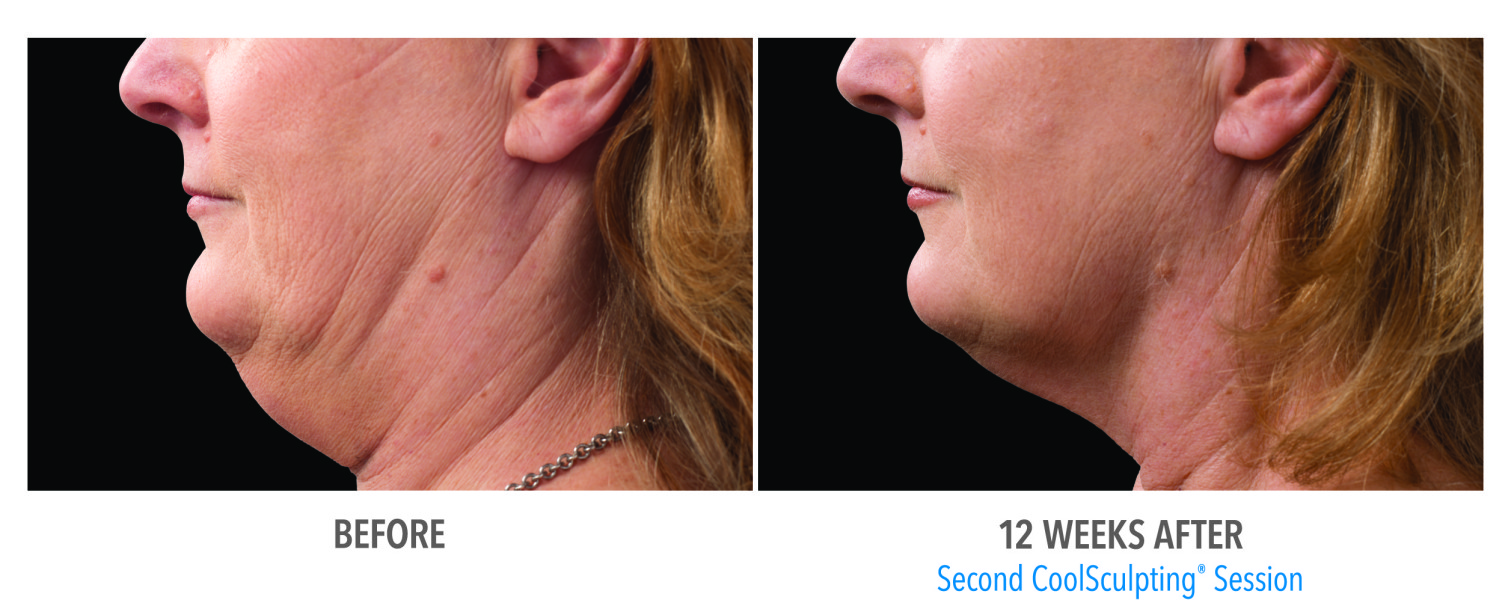 coolsculpting for double chin scottsdale chandler az