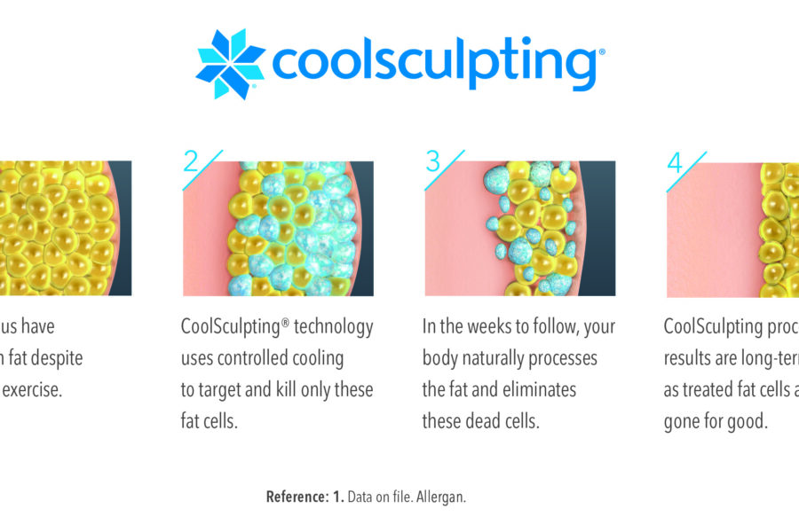 coolsculpting for chin and jawline how coolsculpting works