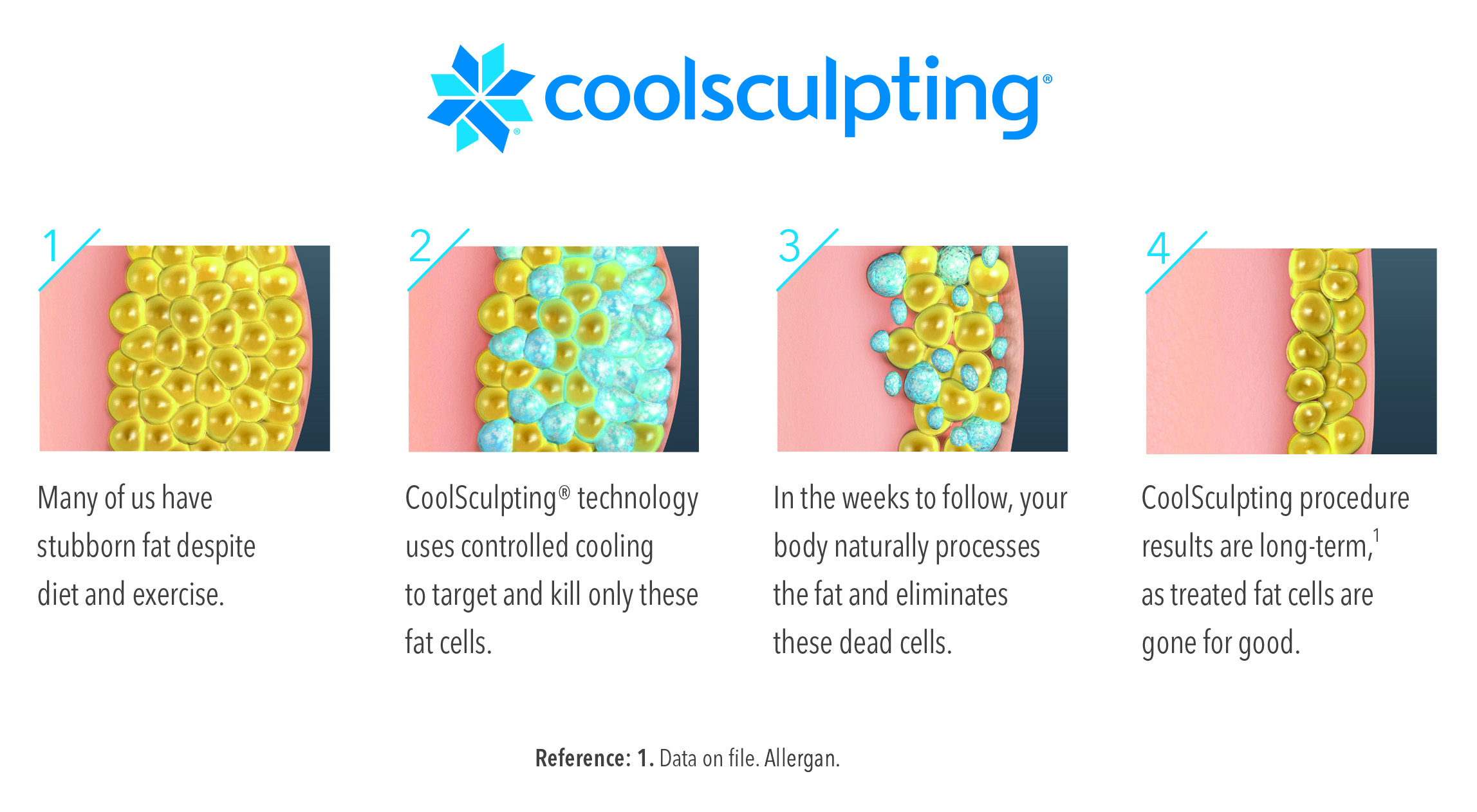 coolsculpting for chin and jawline how coolsculpting works