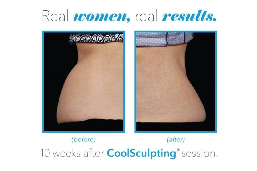 coolsculpting before and after