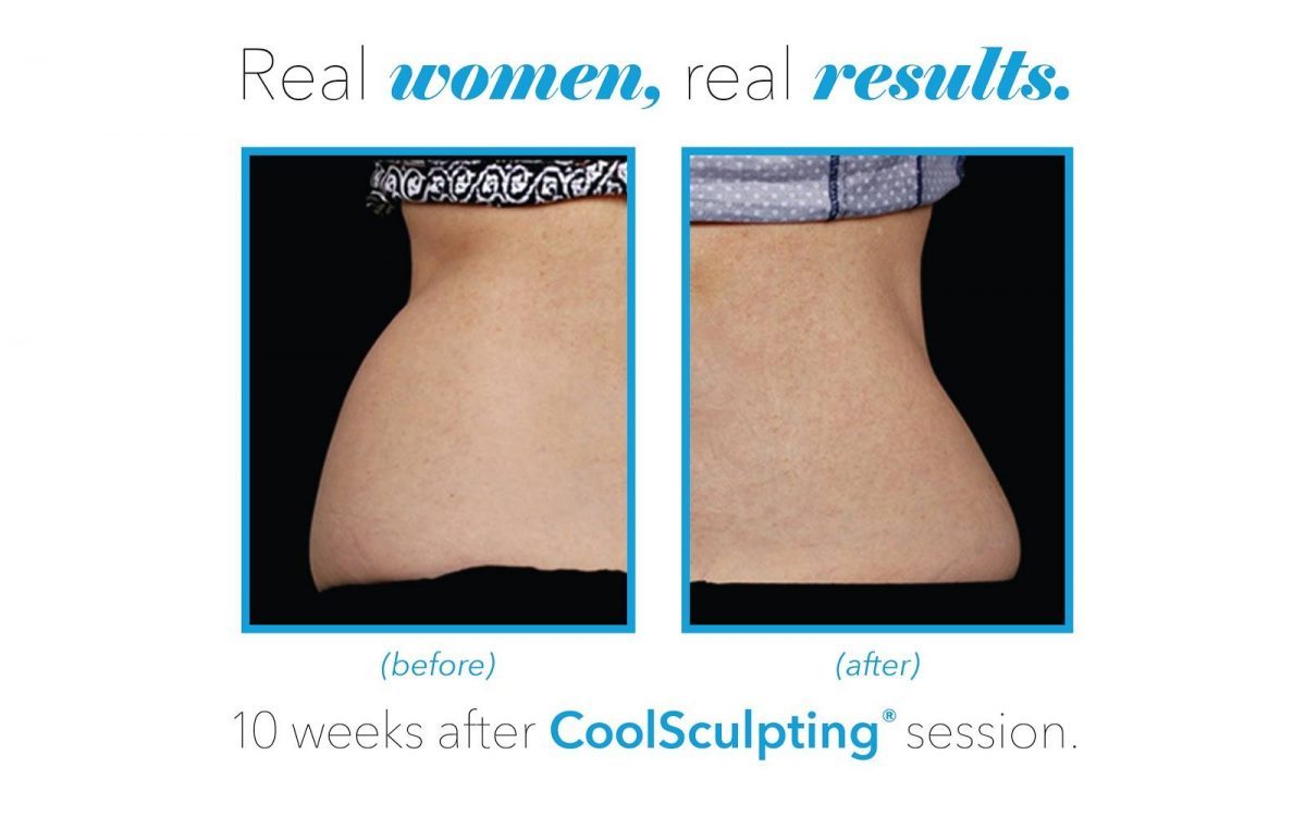 coolsculpting before and after